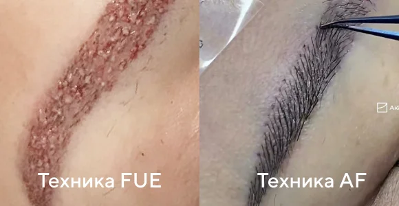 AF Technique