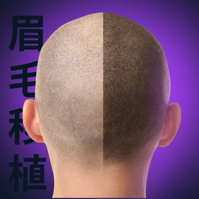 Hair transplant course in China