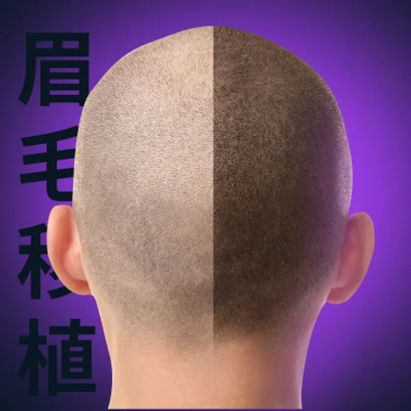 Hair transplant course — training in China