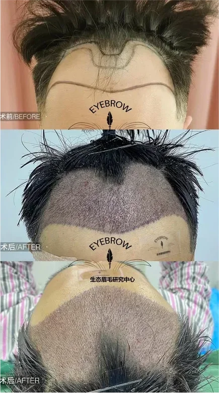 Hair transplant result before and after