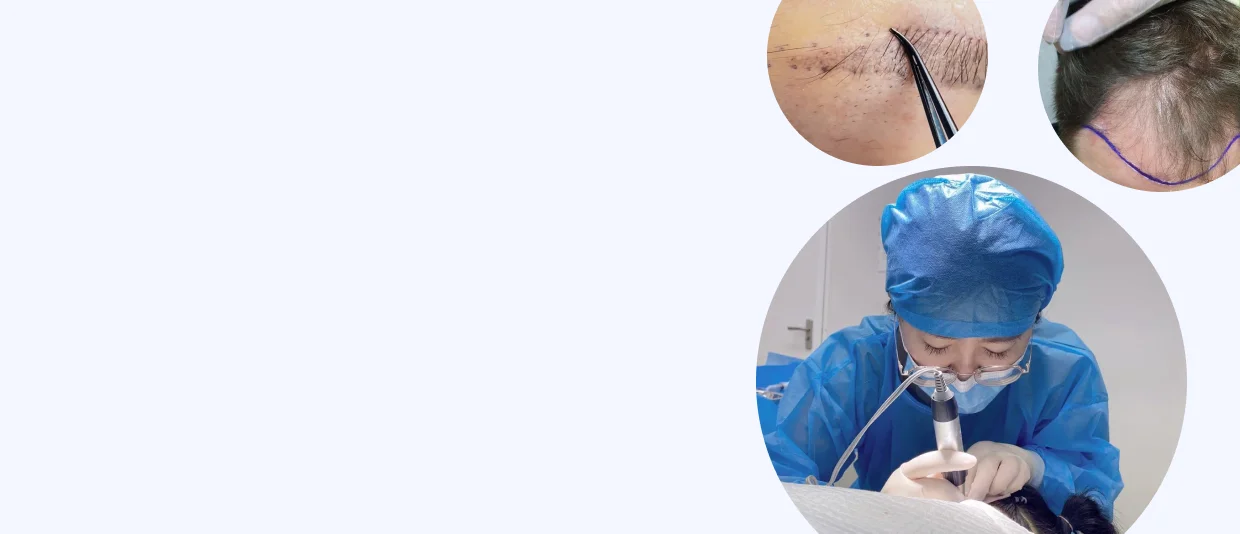 Hair transplant training in China — hands-on practice on the Academy 21 course