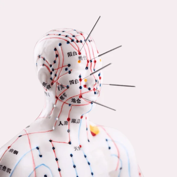 Акупунктура